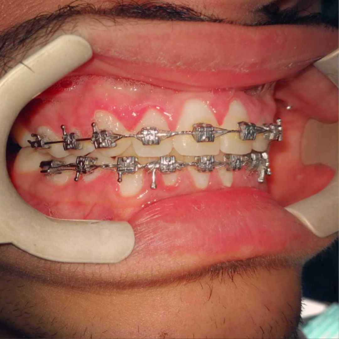 Self Ligating Braces Dental Clinic in Dubai Orthodontist